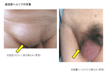 成人の鼠径ヘルニアについて