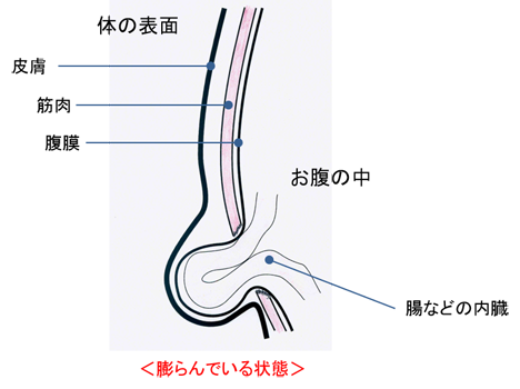 成人の鼠径ヘルニアについて