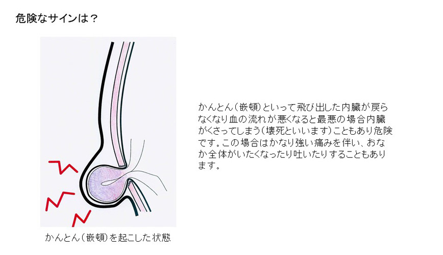 成人の鼠径ヘルニアについて
