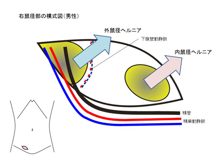 成人の鼠径ヘルニアについて
