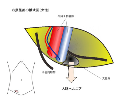 成人の鼠径ヘルニアについて