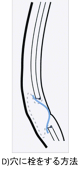 成人の鼠径ヘルニアについて