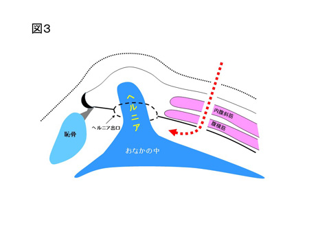 鼠径ヘルニア（成人）の手術方法について（図３）