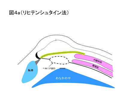鼠径ヘルニア（成人）の手術方法について（図４a）
