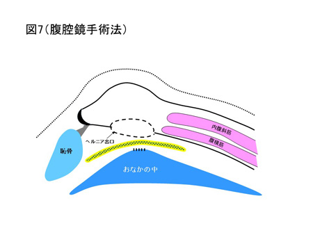 鼠径ヘルニア（成人）の手術方法について（図7）