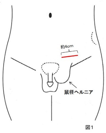 前方到達法（図１）