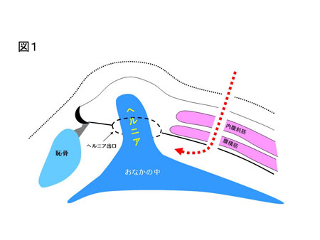 腹膜前到達法（図１）