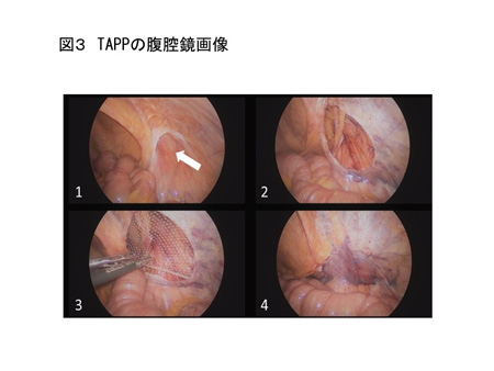 TAPP（図３）