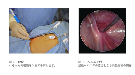 こどもの鼠経ヘルニアの治療方法について（図２）（図３）